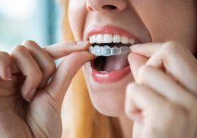 Why You Should Invest In Invisalign