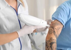 Everything You Need To Know About Skincare Before And After Tattoo Removal