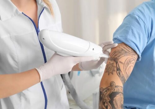 Tattoo Removal