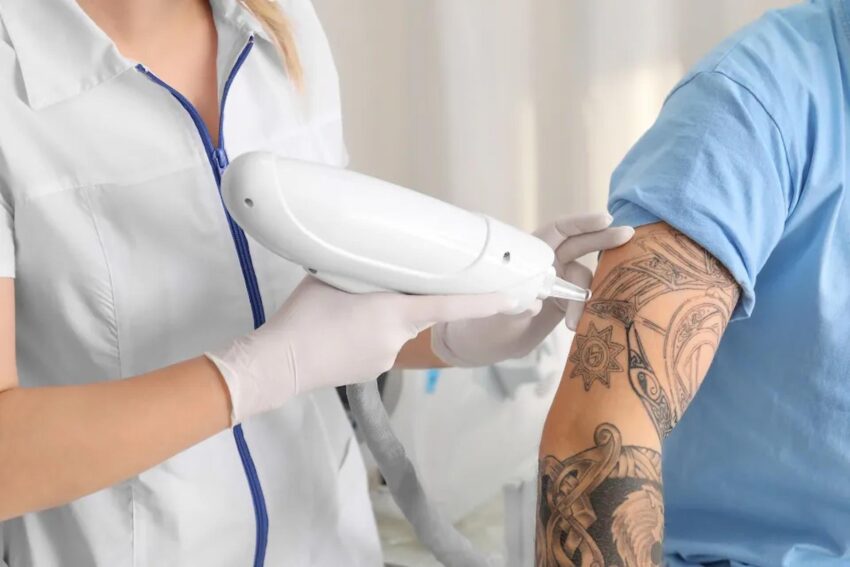 Tattoo Removal