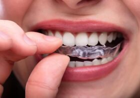 Reasons Why You Should Get Invisalign As An Adult