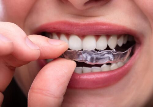 aligner treatments